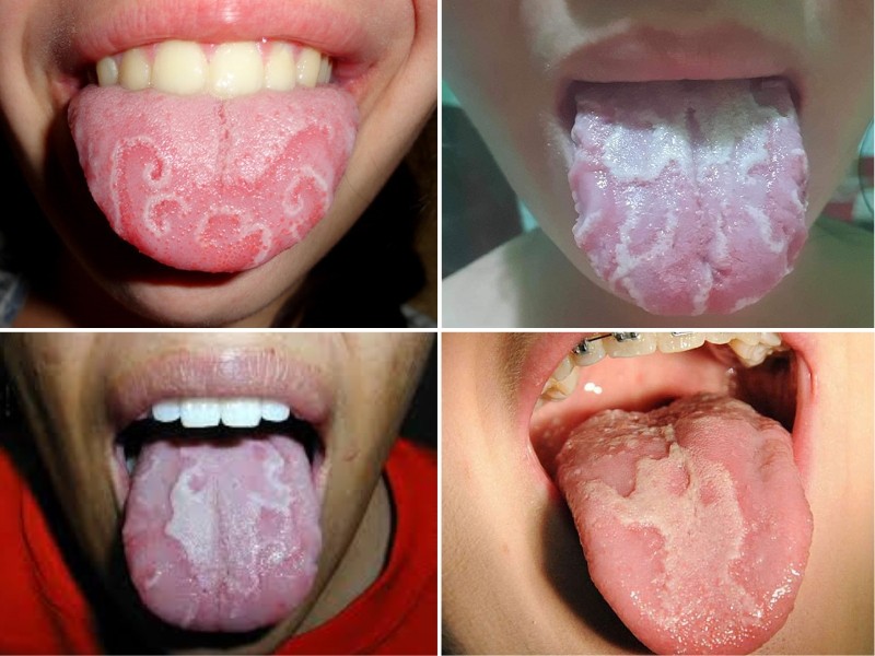 Hình ảnh nấm lưỡi bản đồ